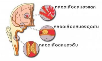 สื่อทางการแพทย์ แสดงอาการ ภาวะสมองขาดเลือดเฉียบพลัน