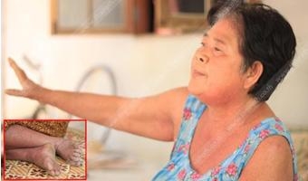 นางอ่อน สิทธิกาลอายุ 61 ปี  ป่วยโรคสะเก็ดเงิน