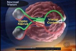 สื่อทางการแพทย์ แสดงภาพจำลองการมองเห็นของดวงตาคนปกติ Normal Vision