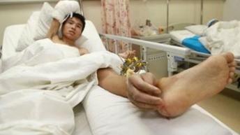 นายเสี่ยวเว่ย  นอนรักษาตัวภายในโรงพยาบาล โดยแพทย์ทำการปลูกถ่ายมือได้สำเร็จ