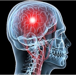 สื่อทางการแพทย์สมองของมนุษย์ โรคหลอดเลือดสมอง