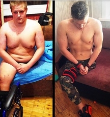 เซอร์เก คูโตวอย ชายพิการขาขาดหนึ่งข้าง กับภาพก่อนและหลังลดน้ำหนัก