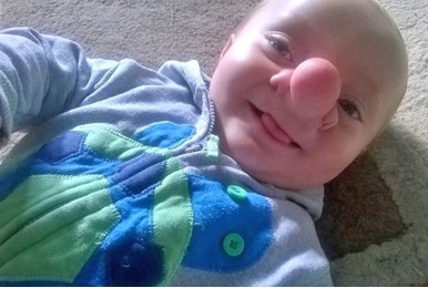 "โอลลี่ เทรซี่" เด็กชายที่เกิดมากับความผิดปกติของจมูกโต