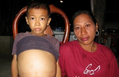 เด็กชายนาคิน ถิ่นวิไล อายุ 10 ขวบ ป่วยท้องโตขับถ่ายไม่ได้