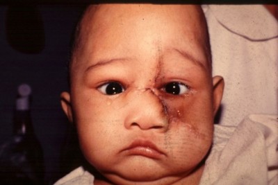 อาจารย์ ‘จรัญ’ แพทย์รางวัลสมเด็จพระวันรัต ผู้บันดาลใจ-มอบชีวิตใหม่ให้ผู้พิการใบหน้า