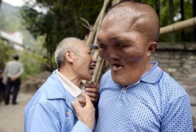  'Xia Yuanhai' วัย 53 ปี มีขนาดใบหน้าที่ผิดปกติ